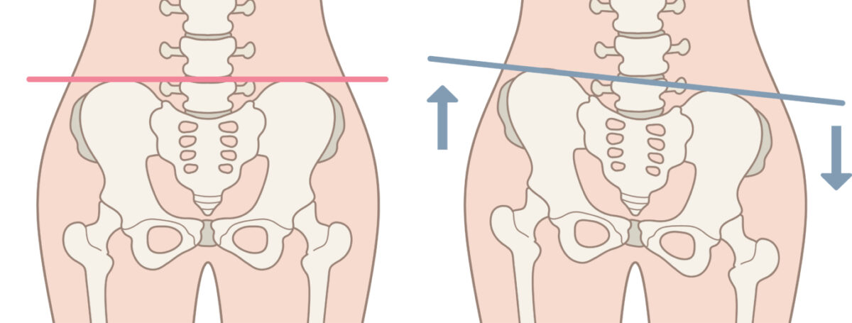 腰痛に関連する骨盤画像