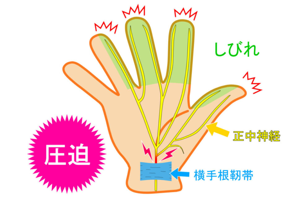 【手根管症候群とは？】手指のしびれ症状と原因治療法