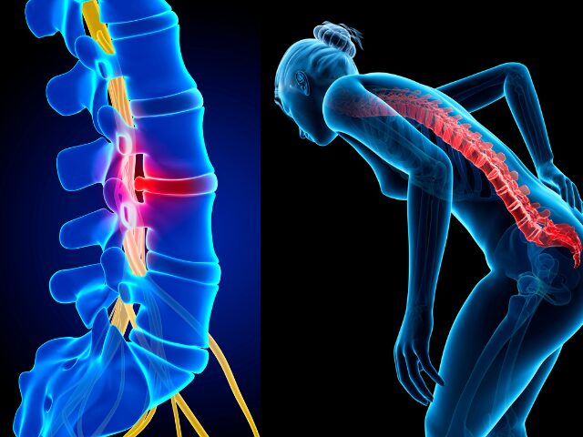腰椎椎間板ヘルニアの原因、症状、診断、治療法、予防策