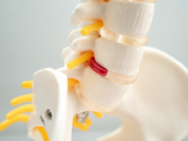 腰椎椎間板ヘルニアの原因、症状、診断、治療法、予防策